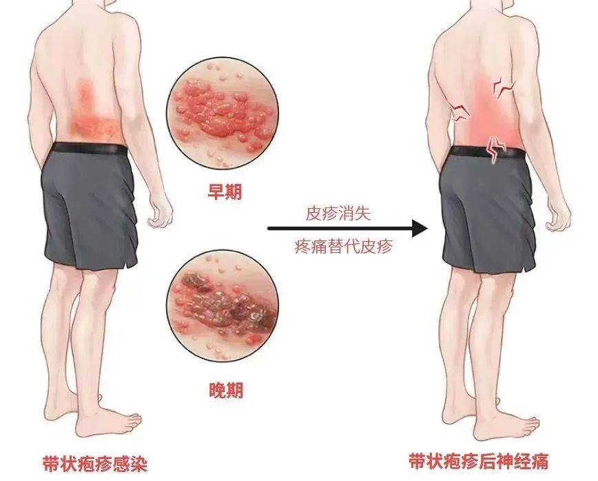 一旦感染终身携带<strong></p>
<p>理财产品排名</strong>！深圳疾控提醒：这4类人要注意