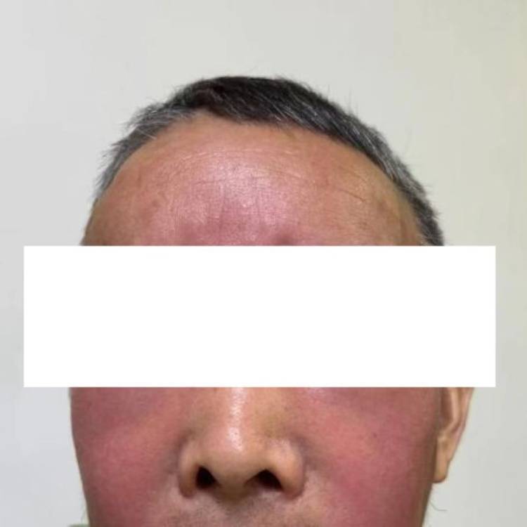 杭州发生多起<strong></p>
<p>理财产品排名</strong>！面部肿成“馒头”！6小时内处理很重要