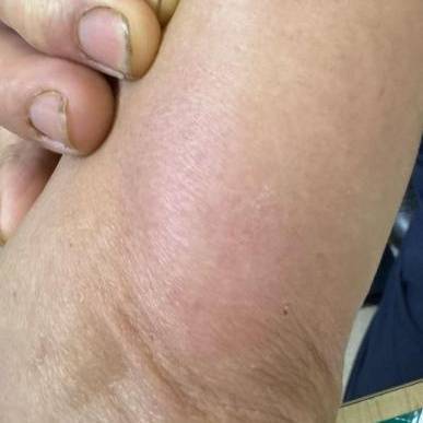 杭州发生多起<strong></p>
<p>理财产品排名</strong>！面部肿成“馒头”！6小时内处理很重要
