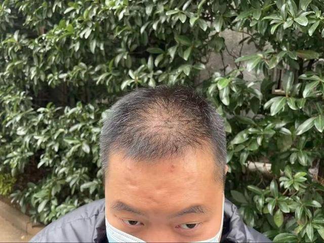 “还能反光<strong></p>
<p>固定收益理财产品</strong>！”长沙男子植发近9月称后脑勺“像狗啃过”