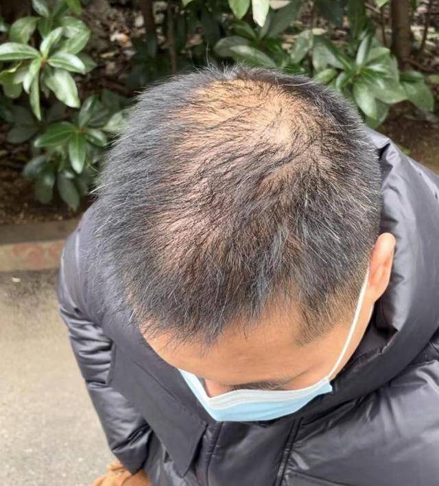 “还能反光<strong></p>
<p>固定收益理财产品</strong>！”长沙男子植发近9月称后脑勺“像狗啃过”