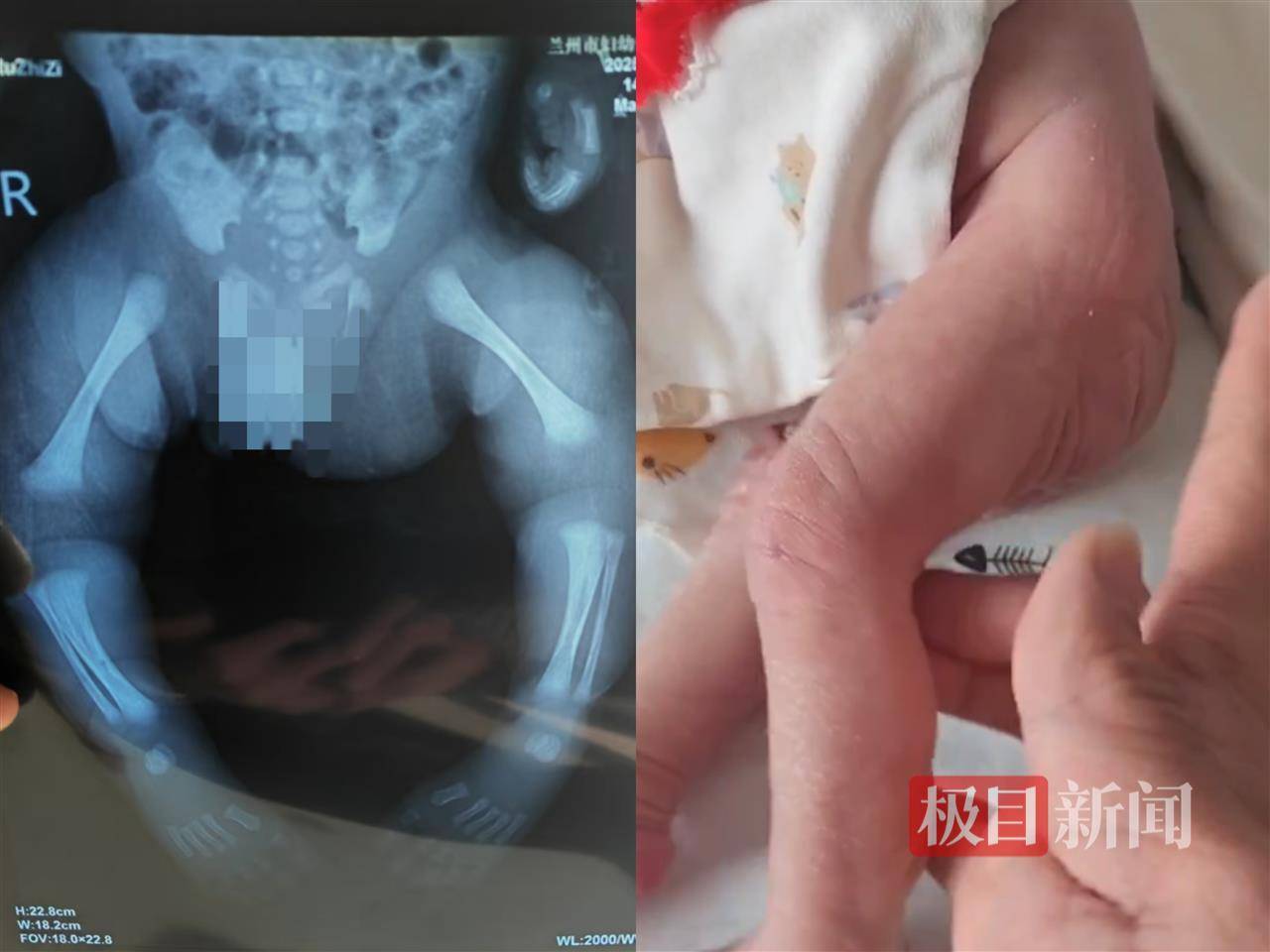 二胎出生查出先天性病症或落下残疾<strong></p>
<p>长期理财产品</strong>，残疾父母称医院产检漏检、未尽告知义务，医院及医调委回应