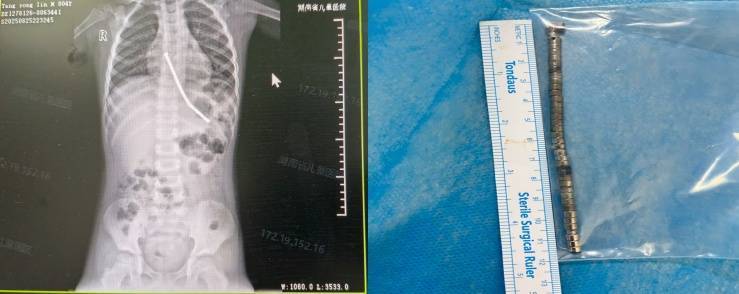 整整40颗<strong></p>
<p>理财产品推销</strong>！湖南3岁男童身体里取出……医生紧急提醒