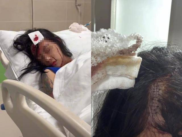 女子被闺蜜酒后用菜刀砍伤头部<strong></p>
<p>理财软件排行</strong>，警方：行政拘留10天