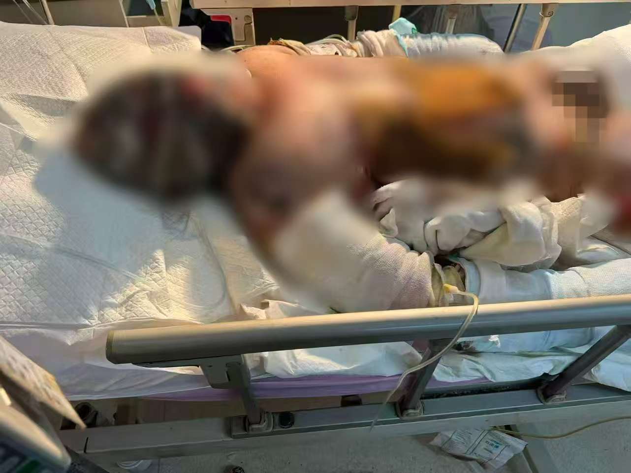 父子在哈尔滨一亲戚公司上班遇爆炸全身烧伤<strong></p>
<p>公募理财</strong>,治疗花费近百万公司拒赔偿?亲戚回应