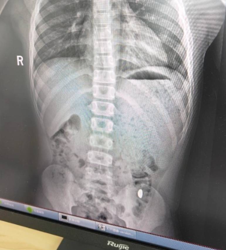 “熊孩子”误吞10克重金豆<strong></p>
<p>理财夜市</strong>,妈妈:天天叮嘱他不要在外面拉屎