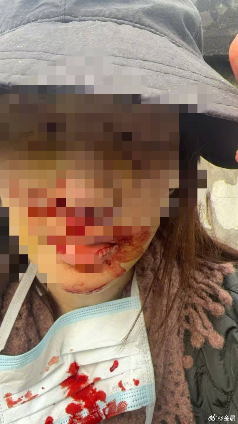 警方发布警情通报后<strong></p>
<p>考理财师</strong>，金晨晒脸部受伤照片并发文道歉