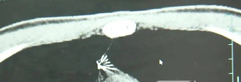 17岁小伙参军体检发现胸腔内有根5cm缝衣针<strong></p>
<p>互联网投资理财</strong>,父母回忆或是1岁时扎入,取出时已锈迹斑斑