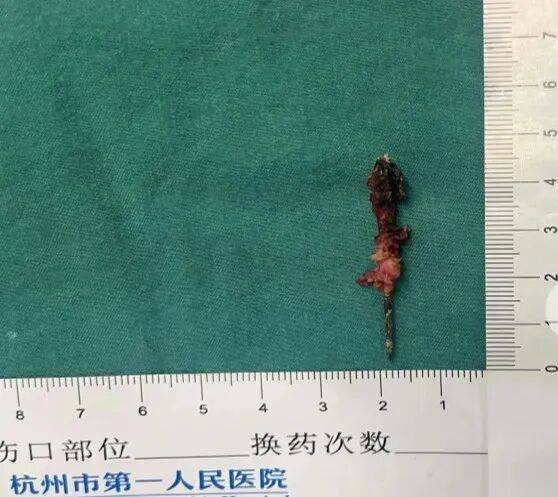 17岁小伙参军体检发现胸腔内有根5cm缝衣针<strong></p>
<p>互联网投资理财</strong>,父母回忆或是1岁时扎入,取出时已锈迹斑斑